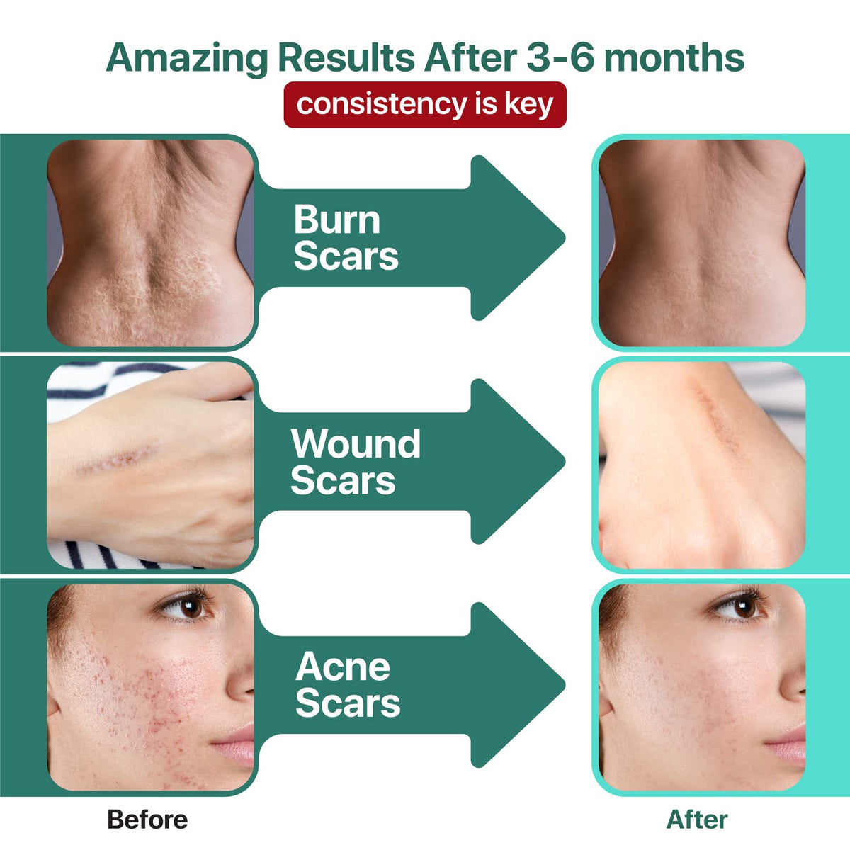 Ebanel Bundle of 30% AHA 2% BHA Chemical Peel and Advanced Silicone Scar Gel