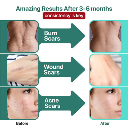 Ebanel Bundle of Advanced Silicone Scar Gel 1 Oz, and Hyaluronic Acid Serum