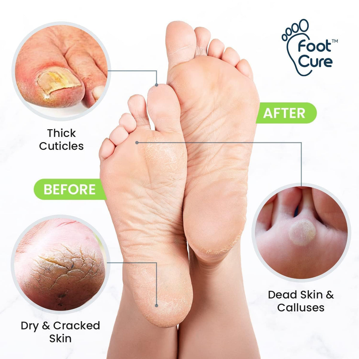FOOT CURE Exfoliator & Callus Remover Pedicure Set – Care Kit Includes File for Dead Skin, Tea Tree Oil Soak Salts, Urea Cream 40 Percent Removal Gel Made in USA, 4 Piece FOOT CURE buy supplements Au