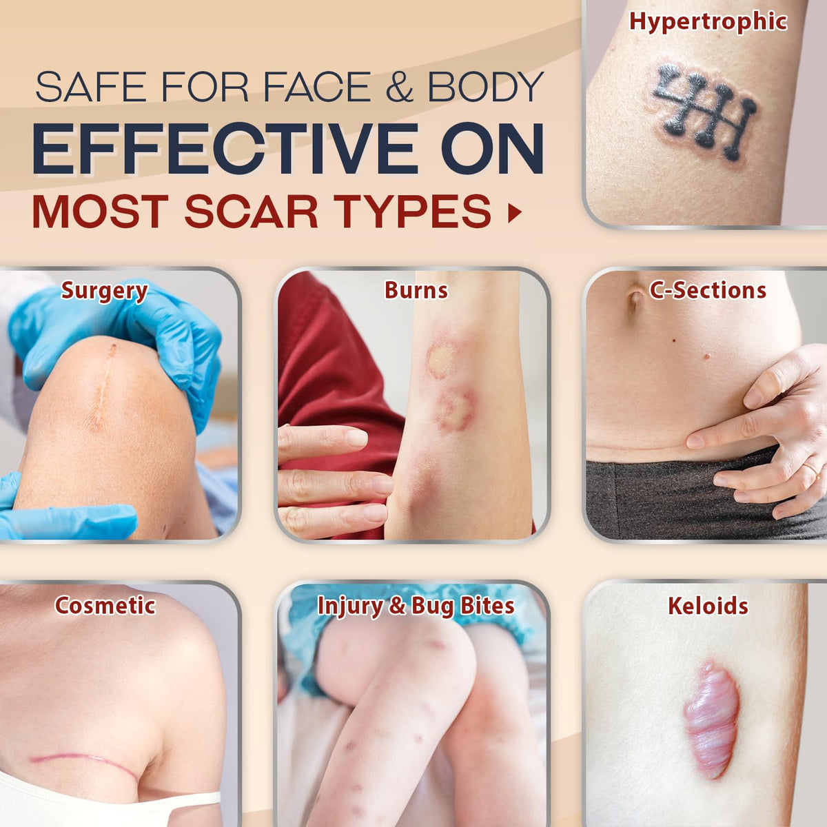 Ebanel Silicone Scar Gel with Allantoin, Emu Oil, Vitamin E and Onion Extract, For Old & New Scars from Surgeries, C-Section, Injuries, Burns & More