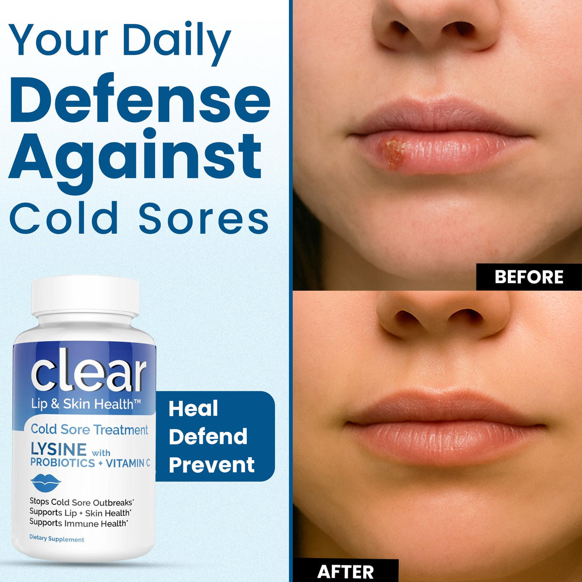 Lysine Cold Sore Treatment for Lips with Pre-Probiotics & VIT C | 1 Month Supply | Supercharged Lysine Capsules with Rhamnosus & Acidophilus for Cold Sores Relief - PrimeBioHealth - canada supplements