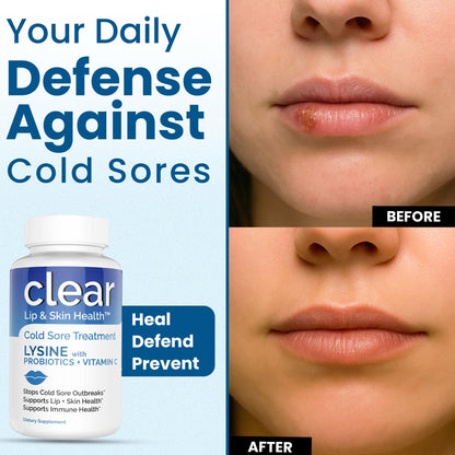 Lysine Cold Sore Treatment for Lips with Pre-Probiotics & VIT C | 1 Month Supply | Supercharged Lysine Capsules with Rhamnosus & Acidophilus for Cold Sores Relief - PrimeBioHealth - canada supplements