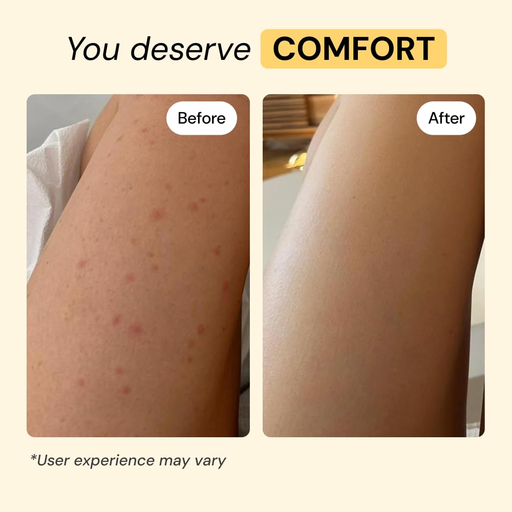 MyMagicHealer Thyme & Tea Tree Flare Care | Cystic Acne, Folliculitis, Ingrown Hair, Keratosis Pilaris, Razor Bumps, Body Bumps, Blind Pimples Multi-purpose Solution - PrimeBioHealth - canada supplements