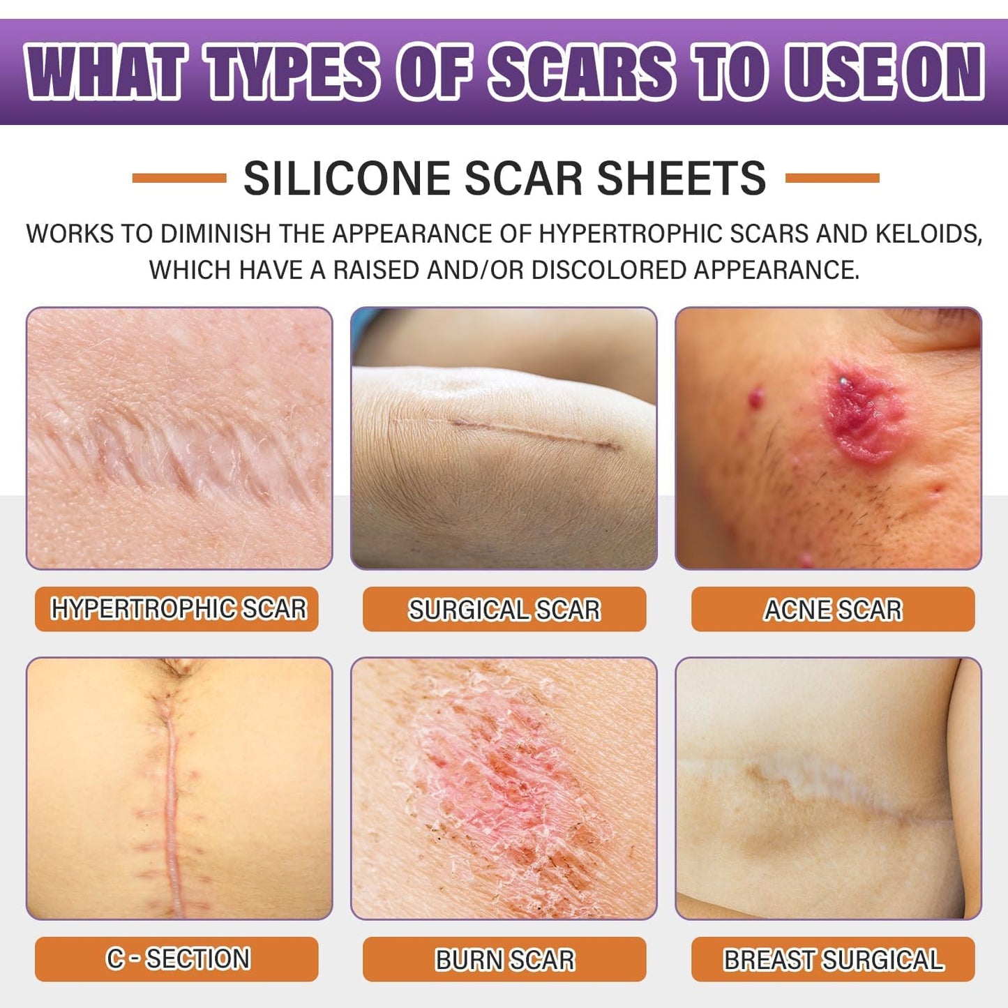 Silicone Scar Sheets,Silicone Scar Tape,Silicone Scar Removal Strips for Surgical,C-Section,Tummy Tuck,Keloid Scars - PrimeBioHealth - canada supplements